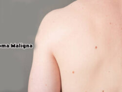 Melawan Melanoma Maligna, Panduan Santai Menuju Kesembuhan