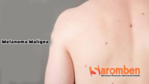 melanoma maligna