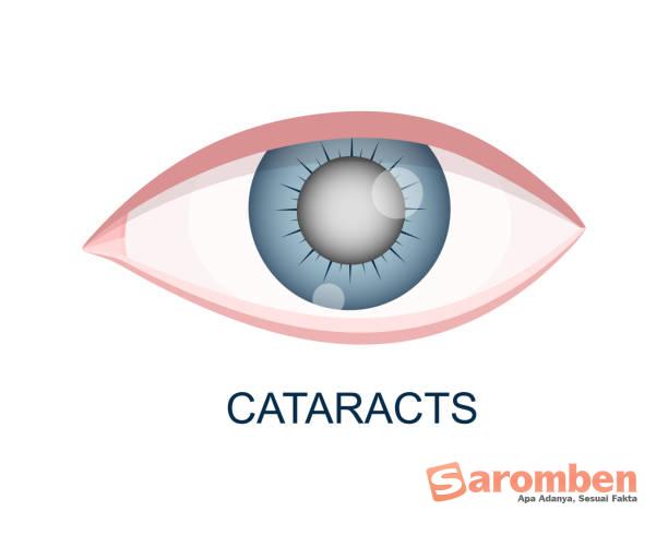Penyebab Katarak